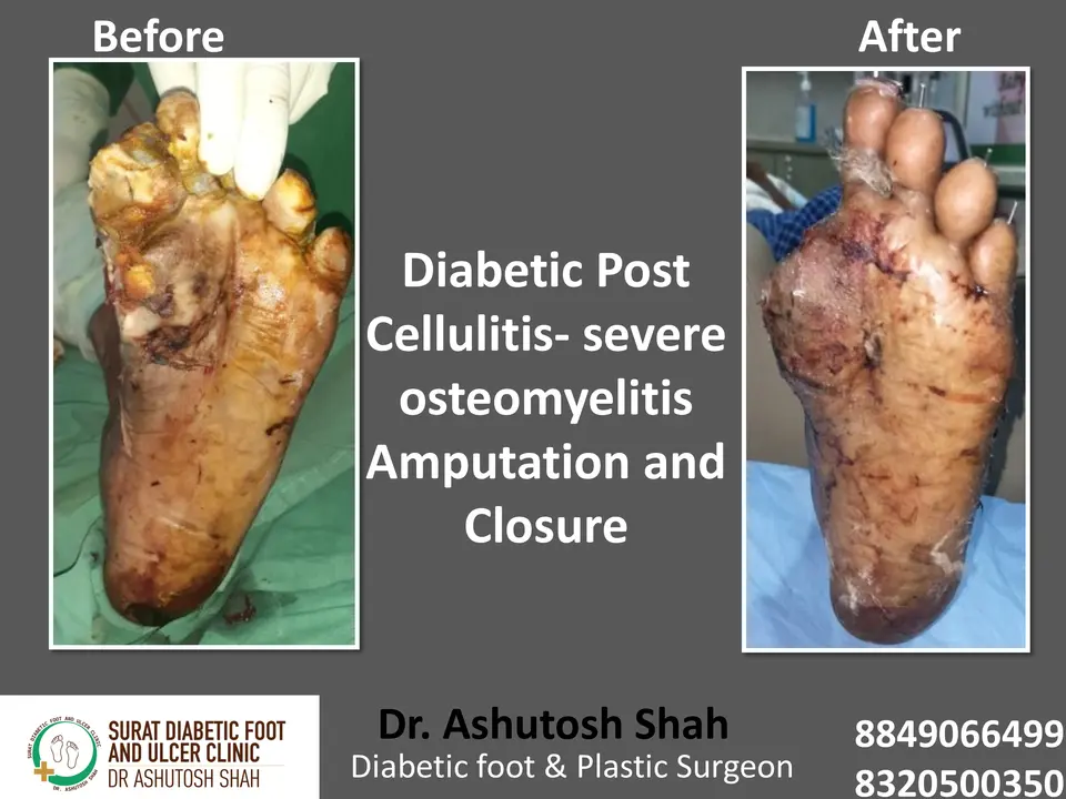 Diabetic Foot  PPT sunita.pptx-46.webp